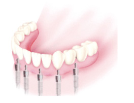 インプラント固定式義歯